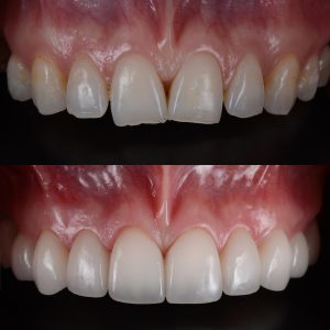 Ceramic,Dental,Veneers,Treat,Crowding,Teeth,,Before,And,After.